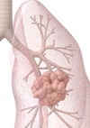 Prevenzione dei tumori polmonari